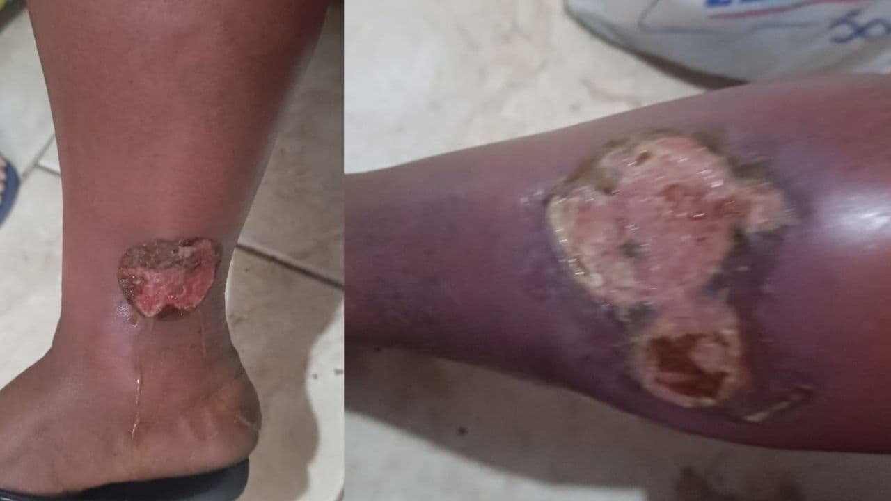 Família pede ajuda para mulher com úlcera na perna conseguir atendimento vascular em Ponta Grossa